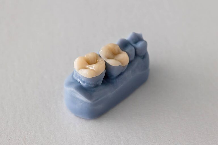 Close-up of blue dental cast showing tooth inlays and onlays.