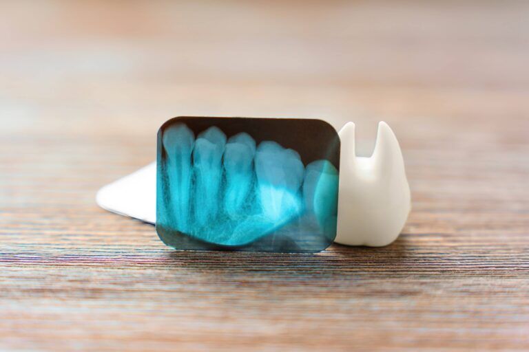 Teeth X-ray and a large white tooth model placed on a wooden background.