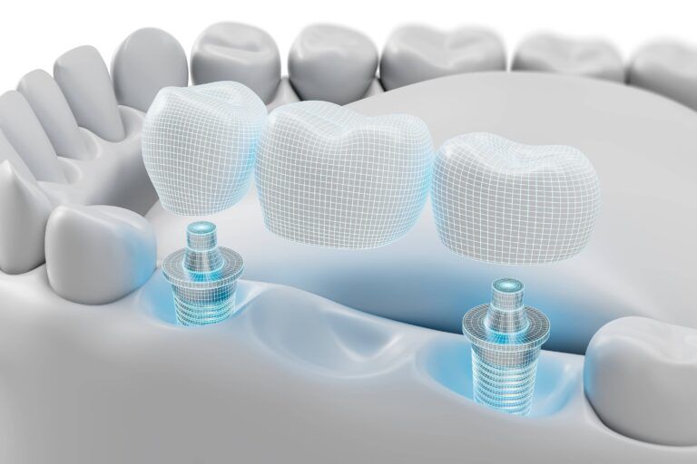 Dental Implants